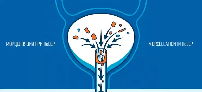 Морцеллятор для лазерной энуклеации простаты (HoLEP, ThuLEP) Richard Wolf Piranha: принципы работы и техника морцелляции